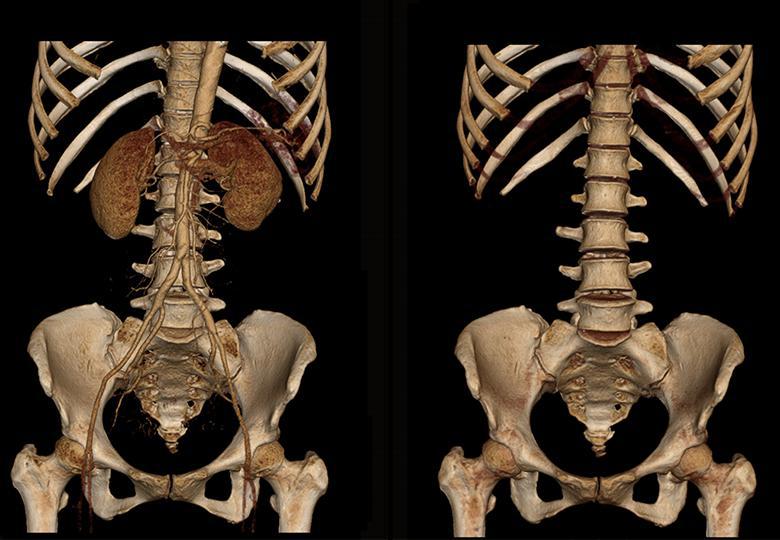  VR reconstruction of the abdominal pelvis 