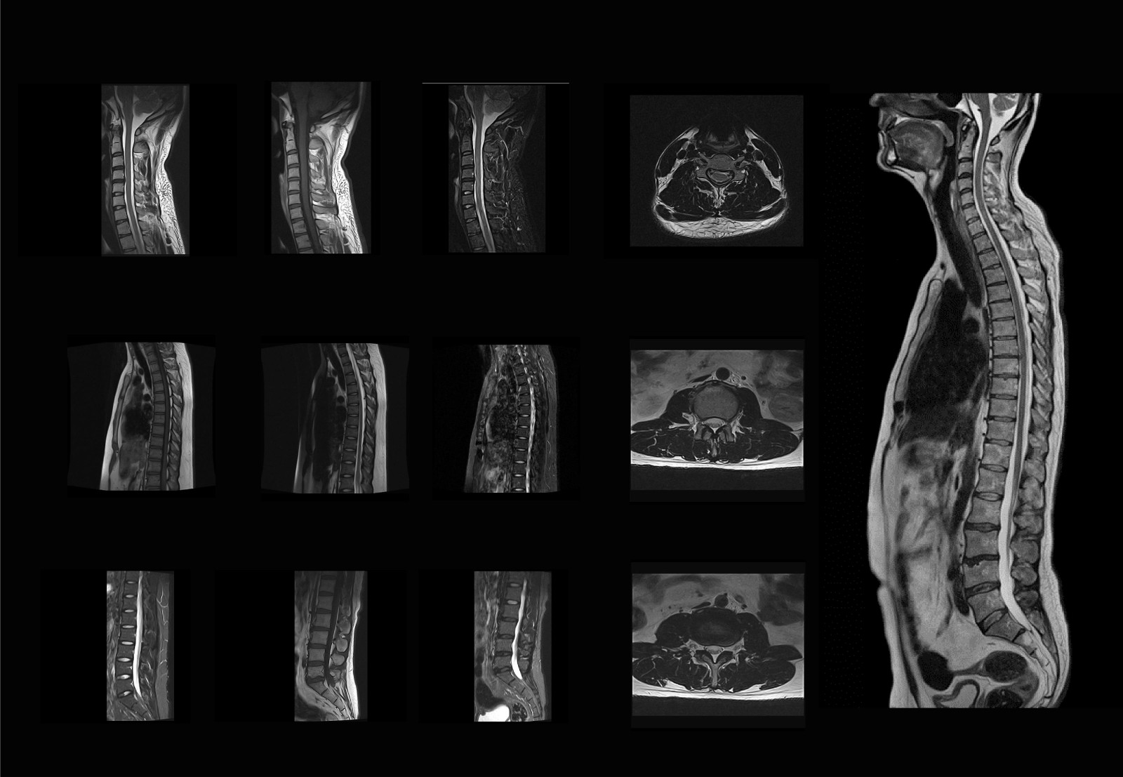 Spine Scan