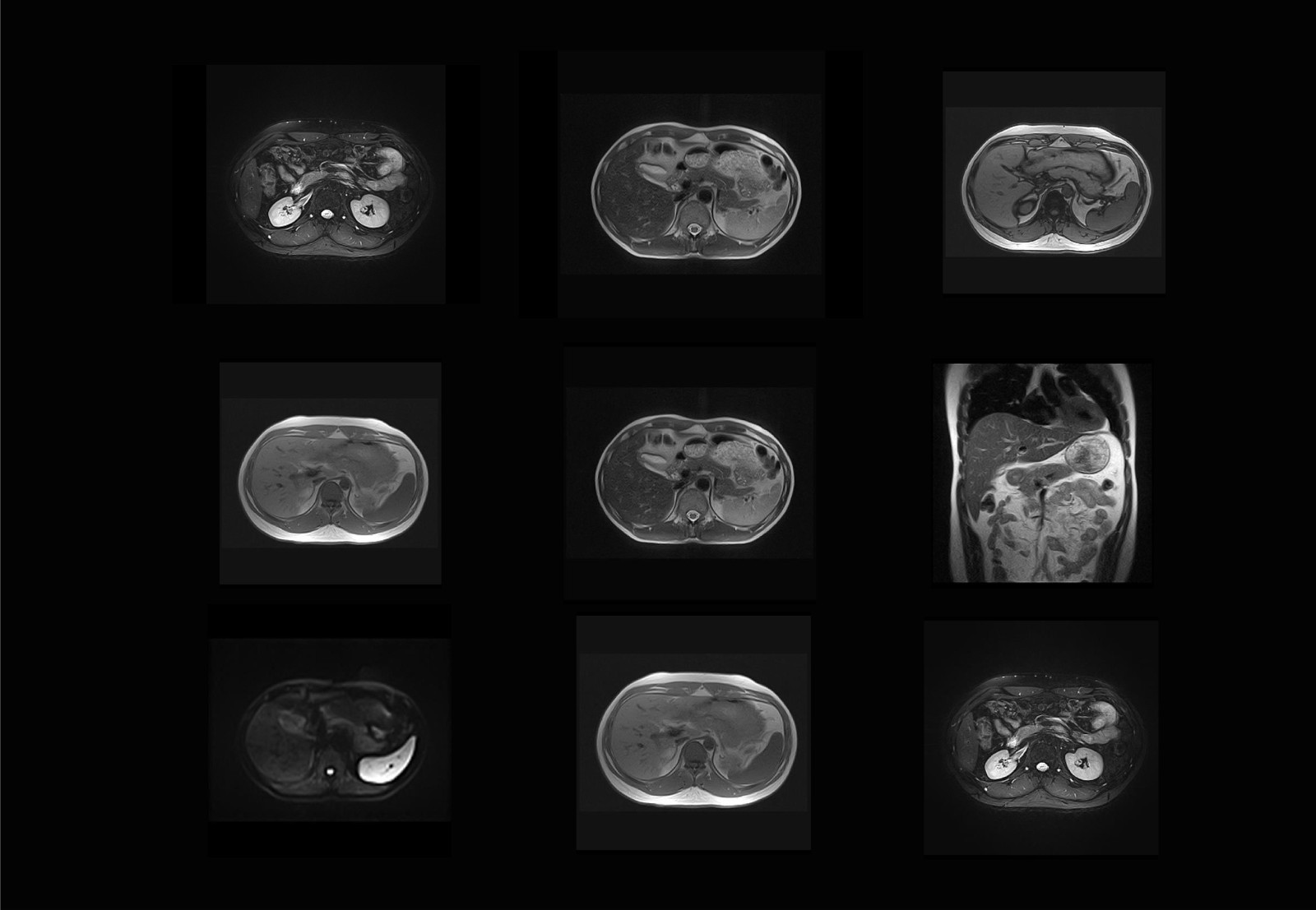 Abdomen Scan